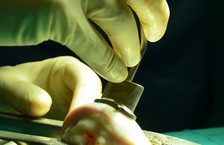 Rádio Regional do Centro: CHUC realiza segundo alotransplante osteocartilagíneo maciço fresco